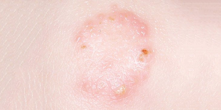 nano bạc trị nấm da